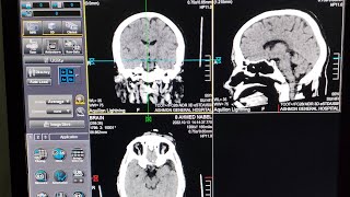 شرح مفصل لفحص الاشعه المقطعيه علي المخ علي جهاز توشيبا الجزء الاول /CT Brain from A to Z screenshot 5