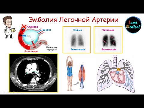 Эмболия Легочной Артерии| Основные аспекты| Патогенез| Клиника| Диагностика| Лечение| Легко и просто