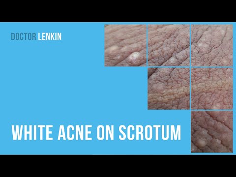 😕 White acne on scrotum