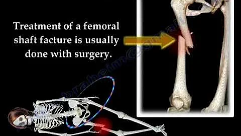 Fracture of the  Femur and  its  fixation - Everything You Need To Know - Dr. Nabil Ebraheim