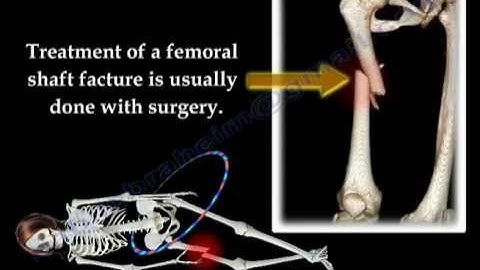 Fracture of the  Femur and  its  fixation - Everything You Need To Know - Dr. Nabil Ebraheim