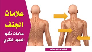 ازاى تعرف ان عندك جنف | علامات الجنف | علامات تشوه العمود الفقرى | علامات انحراف العمود الفقرى