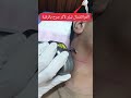 جلسة الفراكشنال ليزر لأثر جرح في الرقبة فراكشنال ليزر جلسة الفراكشنال ليزر لأثر جرح في الرقبة فراكشنال ليزر