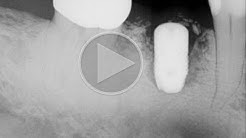 Implant failure in GOOD bone 