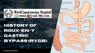 History of Roux-en-Y gastric bypass (RYGB) - Dr. Manish Baijal