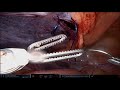 ATX Robotic Surgery - Robotic Inguinal Hernia Repair #1