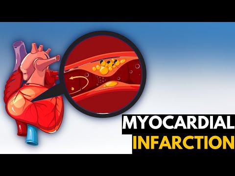 Video: Kokių simptomų tikimasi pacientui, sergančiam ūminiu miokardo infarktu?