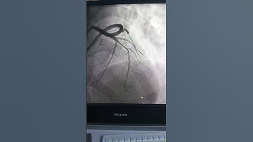 Coronary Angiogram & Coronary Angioplasty