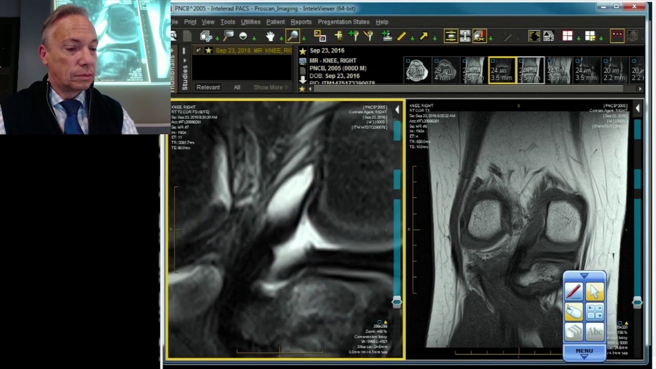Meniscus MRI Case Review: Root Tear