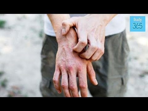 Video: Complicanze Della Dermatite Da Contatto: L'infezione è Comune?