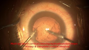 Phacoemulsification in soft cataract