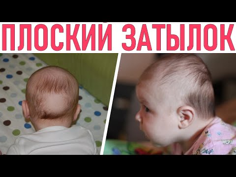 У РЕБЕНКА ПЛОСКИЙ ЗАТЫЛОК | У каких детей чаще бывает плоский затылок