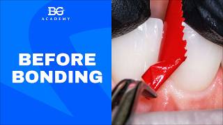Before Bonding: Try-In & Fit Control of Ceramic Restorations