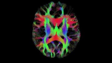 Fibretracts of the human brain