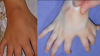 Mirror Hand Syndrome Ulnar Dimelia A Rare Congenital Hand Deformity