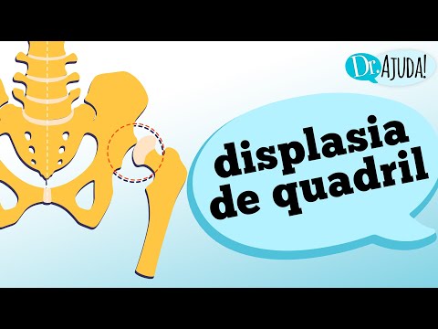 Vídeo: Displasia Da Articulação Do Quadril - Sintomas, Tratamento, Formas, Etapas, Diagnóstico