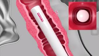 L Rejuvenation Non Invasive Hifu High Intensity Focused Ultrasound