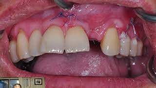 Immediate Loading on Dental Implant and Grafted Site