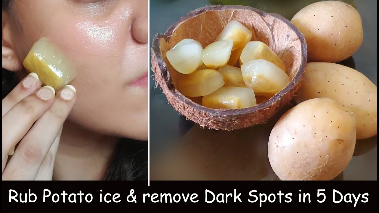 i rub Potato Ice cubes daily & removed DARK SPOTS in 7 Days Closed