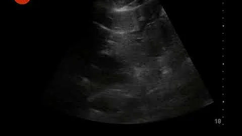 Video 9   Tutorial on ultrasound of the Inferior Vena Cava
