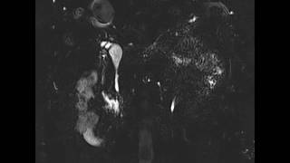 Choledochal Cyst With Apbj