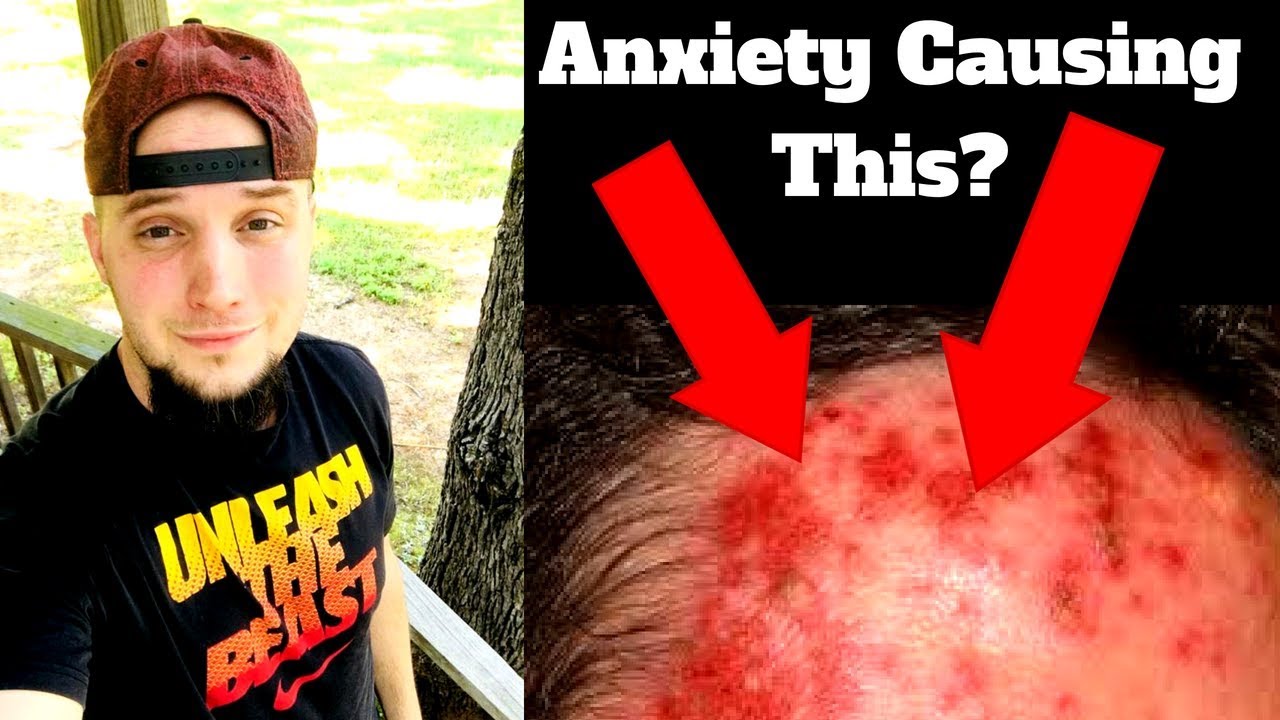 5 Reasons Why Anxiety Causes Acne!