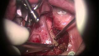 Tonsil Cancer Resection with Elevate ENT CO2 Laser