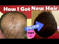 Regrow Hair In 2021, Tried N Tested Working Remedies For Hair Regrowth | Stop Hair Fall And Baldness