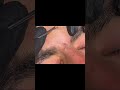 Tag removal black head #skincare #shorts