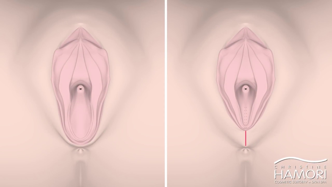 Post Op Vaginoplasty Post Op Vaginoplasty
