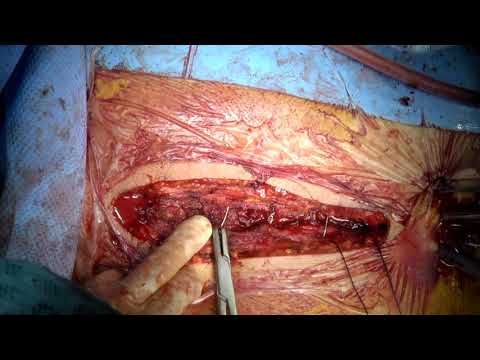 4DryField PH – Hemostasis during sternal closure