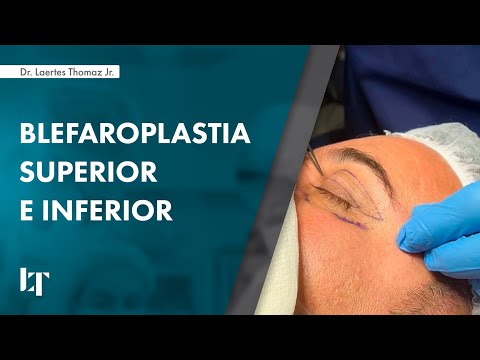 Vídeo: O que é blefaroplastia superior?