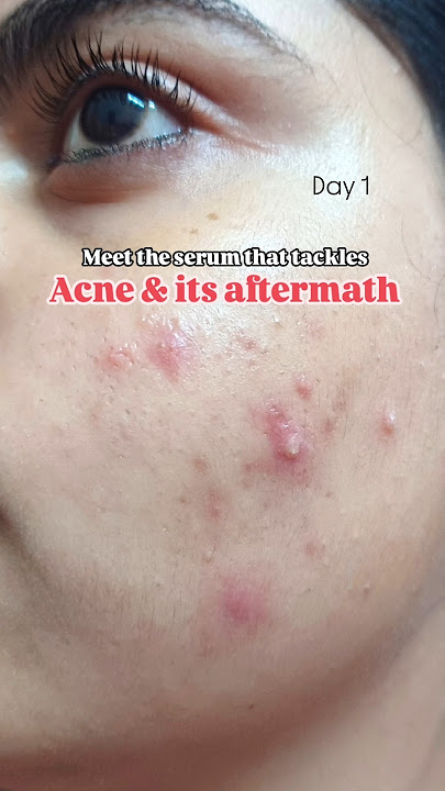 Truth & Beauty Porebright Serum | Azelaic Acid Serum | Serum for Acne & Acne marks #acnetreatment