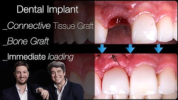 Dental Implant: front teeth Extraction + Implant + Connective Tissue + Bone Graft +Immediate loading
