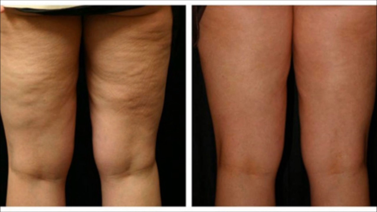 THIS HOMEMADE TREATMENT WILL REMOVE YOUR CELLULITE AFTER ONLY 7 DAYS OF how-long-does-self-tanner-last-before-it-expires-tan-safely
