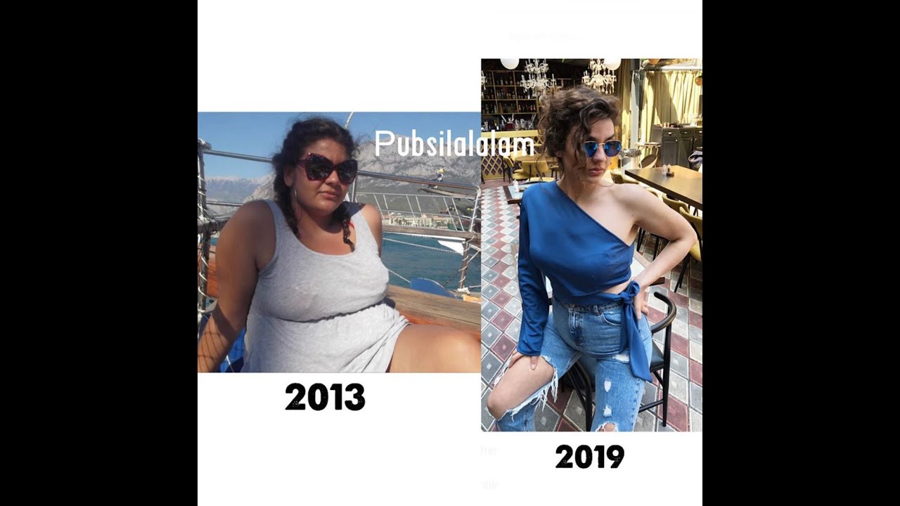 Tüp Mide Ameliyatı ile Nasıl Tanıştım ? #tüpmide