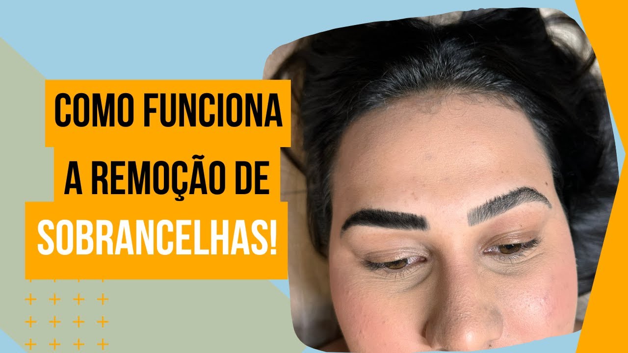 Saiba como funciona a REMOÇÃO A LASER!