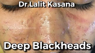 Dr.LalitKasanaによる深いBLACKHEADの除去/新しいビデオ