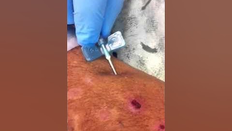 Buttonhole Technique: Self Cannulation