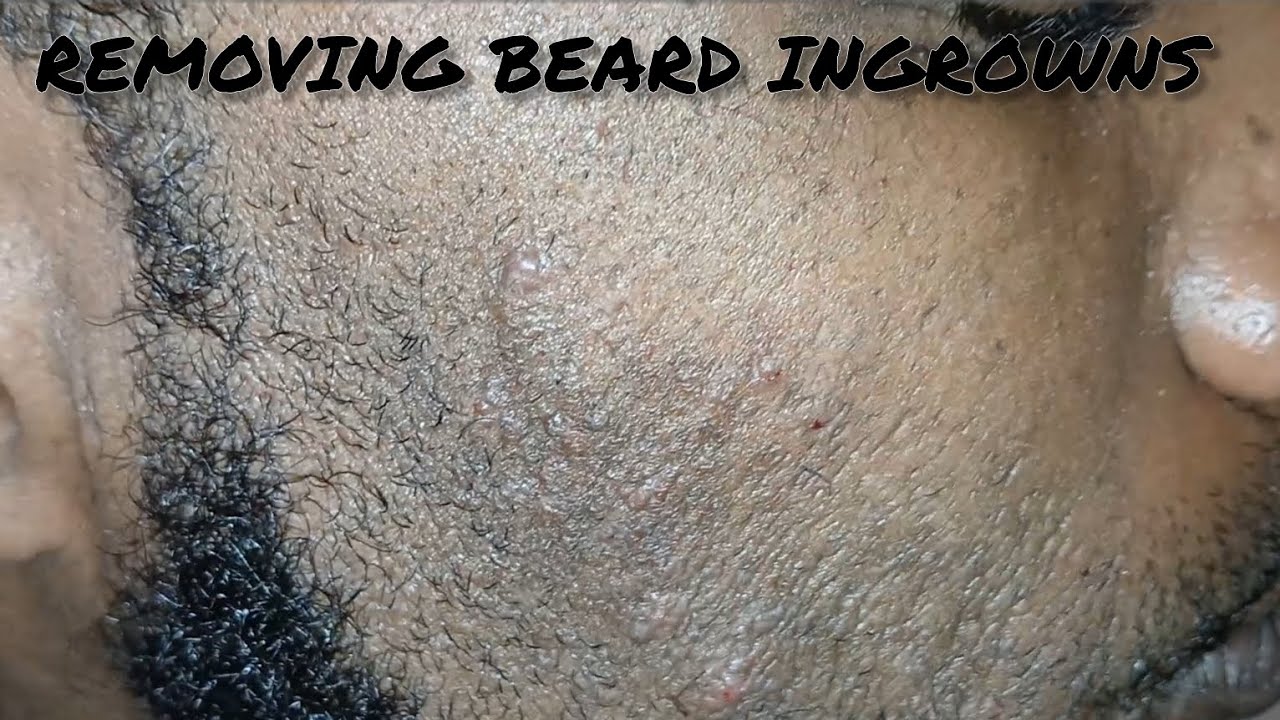 Removing Ingrown Hairs on My Man's Beard YouTube