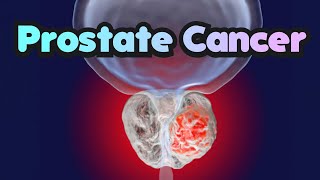 Prostate Cancer  CRASH! Medical Review Series