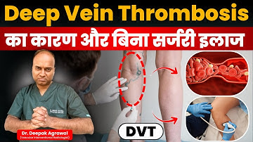 Deep Vein Thrombosis क्या और क्यों होता है? | DVT Treatment Without Surgery