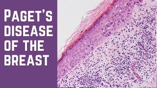 Paget's Disease of the Breast - Pathology mini tutorial