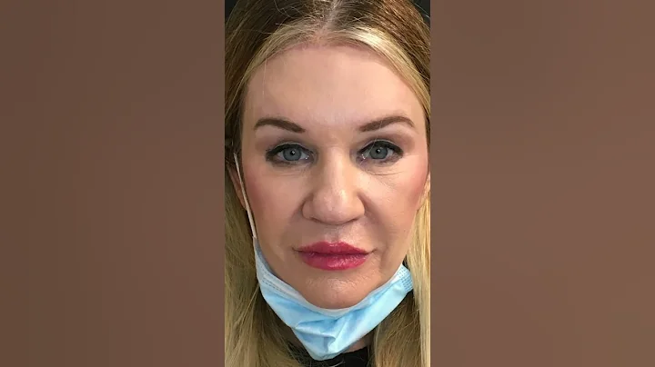 Brow lift and Blepharoplasty | @jacksonaestheticsmd