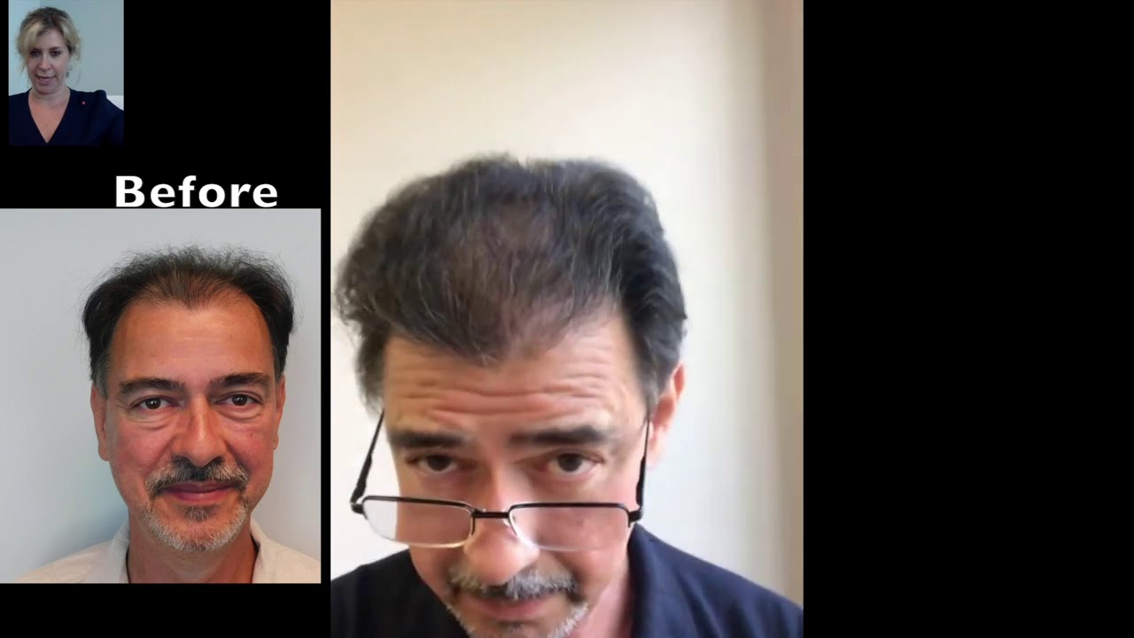Great Natural Hair Transplants Boca Raton Natural Transplants, Hair Restoration Clinic in Boca
