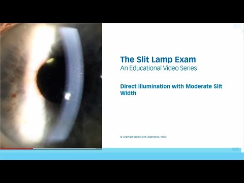 The Slit Lamp Exam – Episode 4, Direct Illumination with Moderate Slit Width