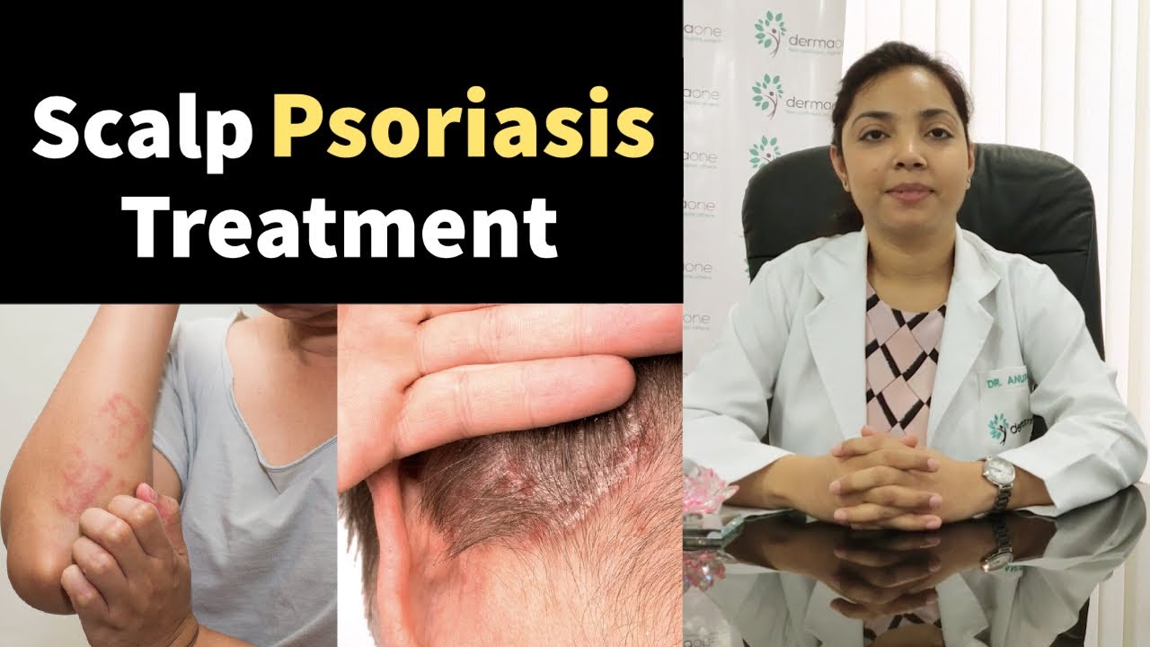 how to cure psoriasis permanently on head vörös foltok jelentek meg az arcon mi ez