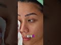 At-Home Mole Removal Trend Everyone’s Talking About ✨