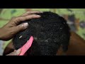 Natural Dandruff On Left Side!!(Giant Flakes) | Dandruff Storm Scratching Satisfying #275