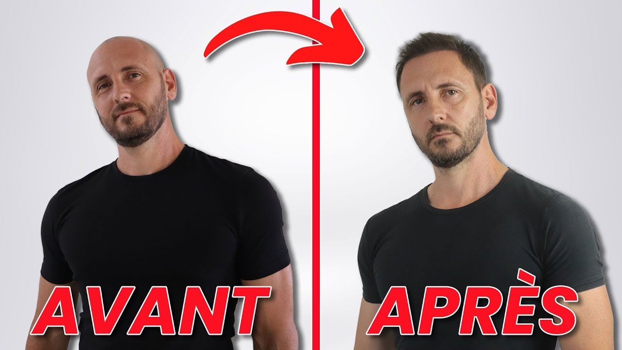 La greffe de cheveux a changé ma vie !